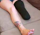 avvocato per risarcimento invalidità permanente gamba Ostia Antica